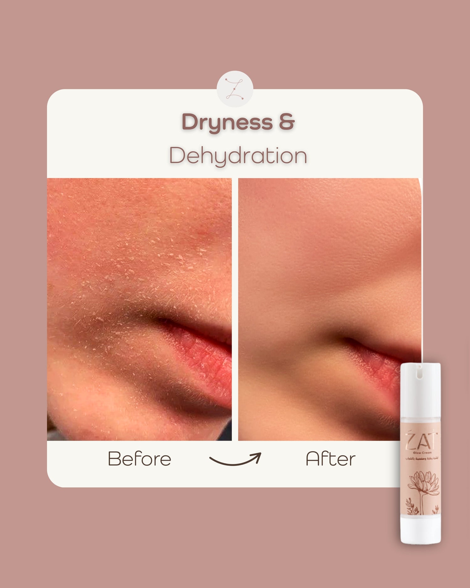 Dryness & Dehydration